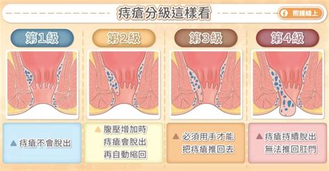 為什麼會長痔|長痔瘡怎麼辦，會自己好嗎？ 10大造成原因、9招預防。